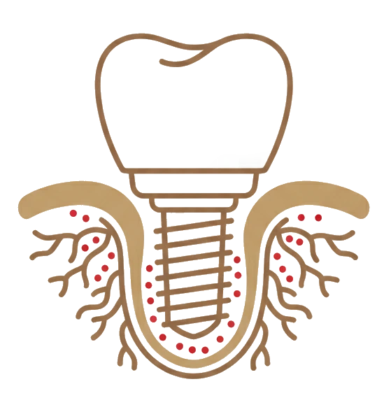 Periimplantitis que recae