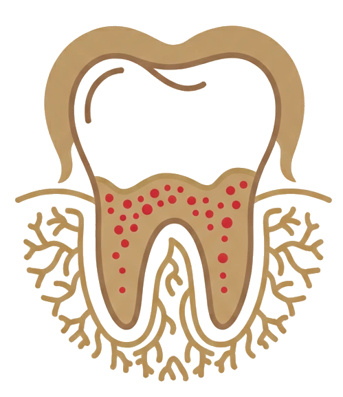 Periodontitis de difícil control